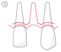Diagram of Fractured tooth removed