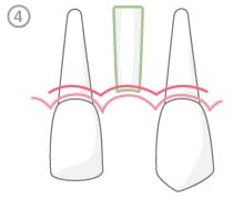 Diagram of Implant placed at the time of tooth removal
